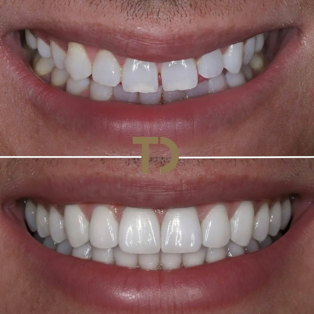Close-up of a smile before and after dental treatment, showing uneven, slightly discolored teeth in the top image and even, bright white teeth in the bottom image.