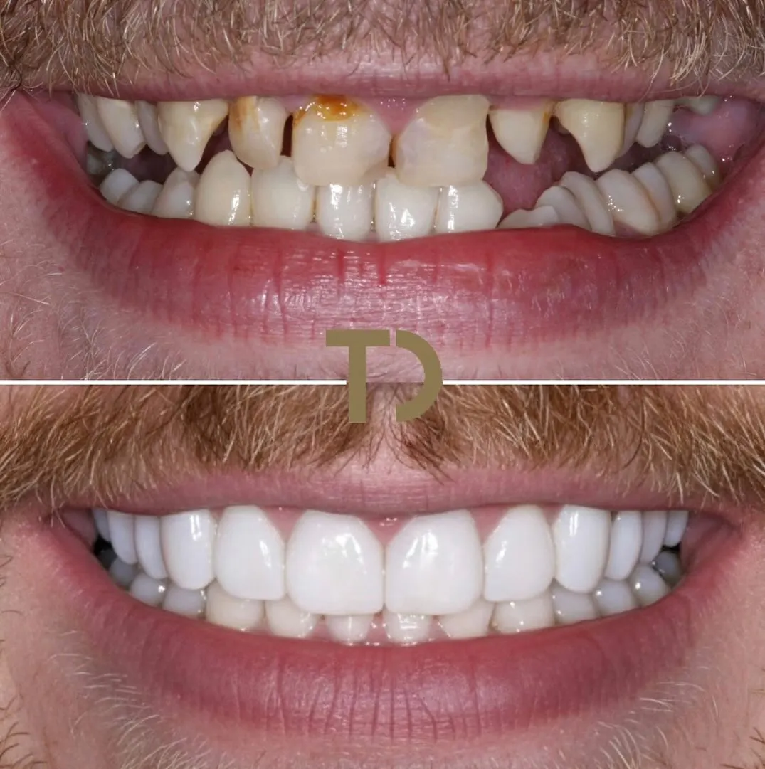 Upper teeth with severe decay, discoloration, and missing teeth above a lower lip; lower teeth repaired, aligned, and white in a after dental treatment smile.