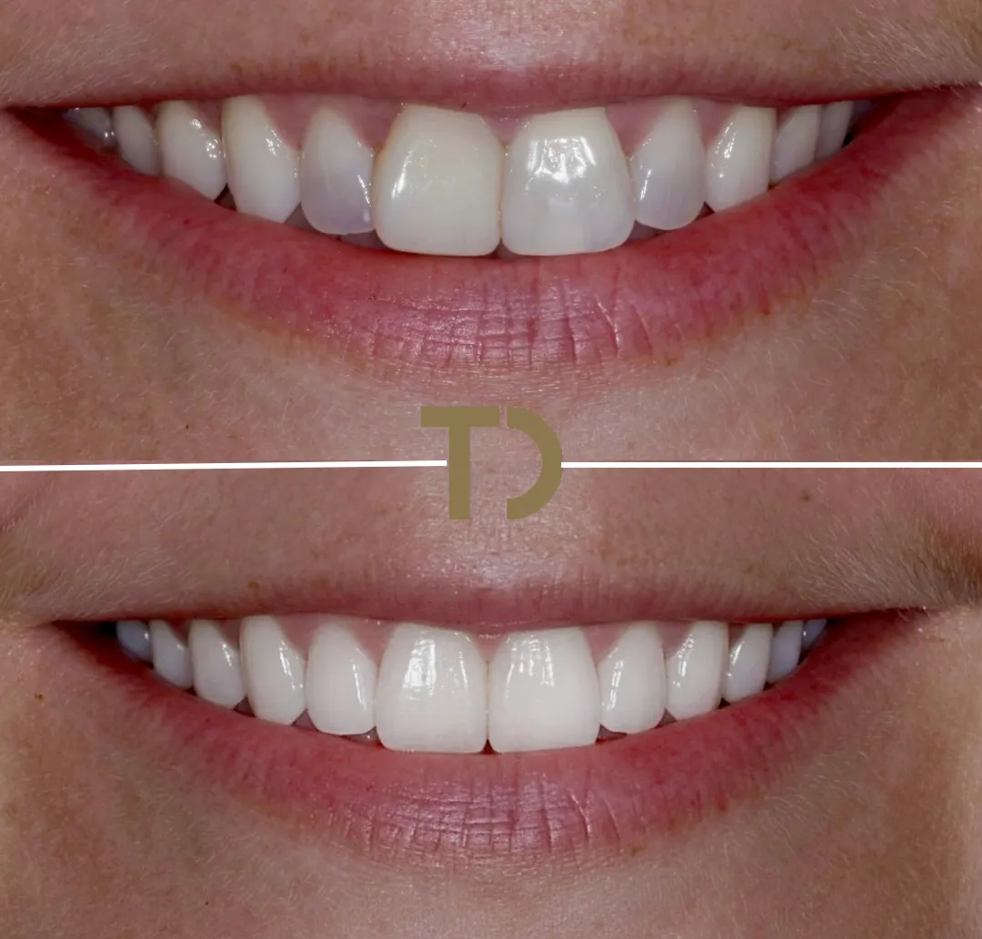 Close-up comparison of a smile showing upper front teeth before and after dental treatment, with teeth appearing straighter and whiter in the after image.