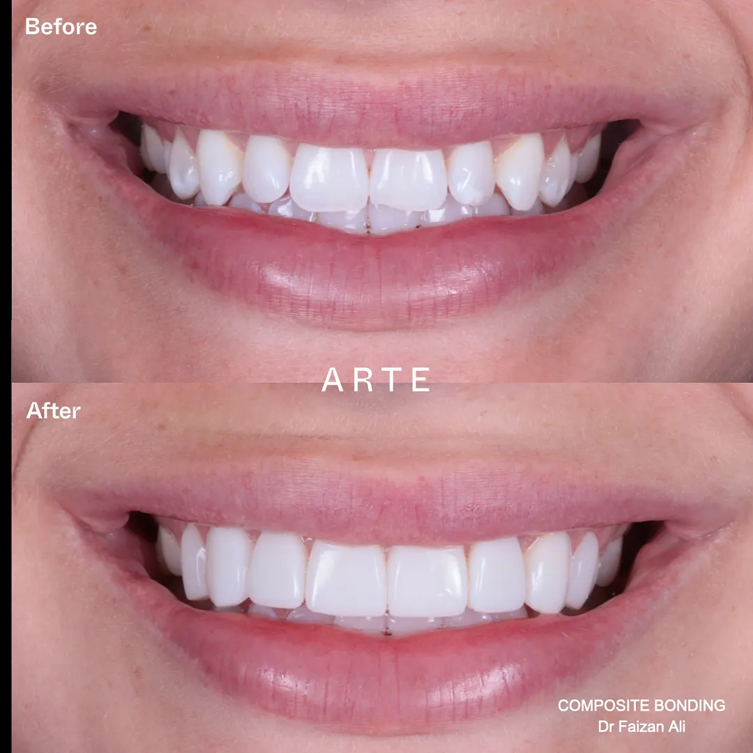 Composite Bonding Results