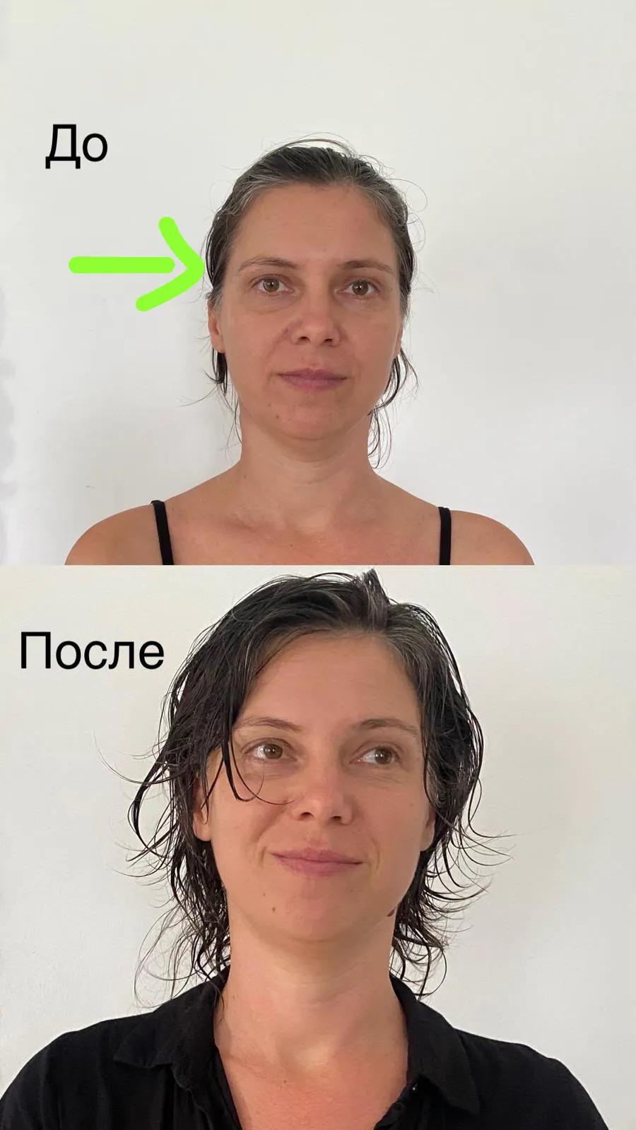 Before and after facial transformation showing reduced swelling and lifted appearance