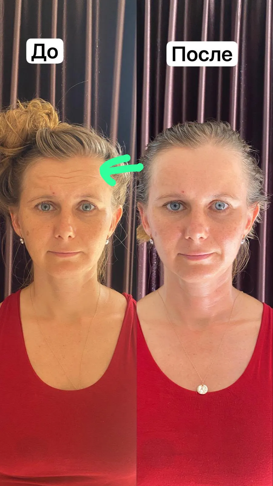 Before and after facial transformation showing reduced forehead tension and softer expression