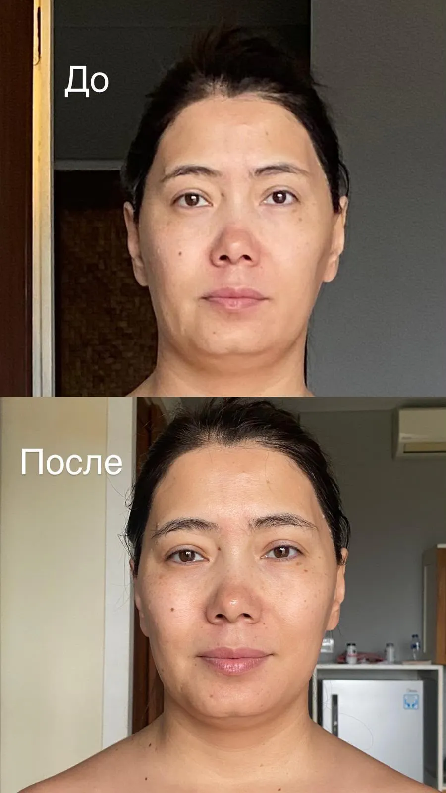 Before and after facial transformation showing reduced swelling and more sculpted jawline