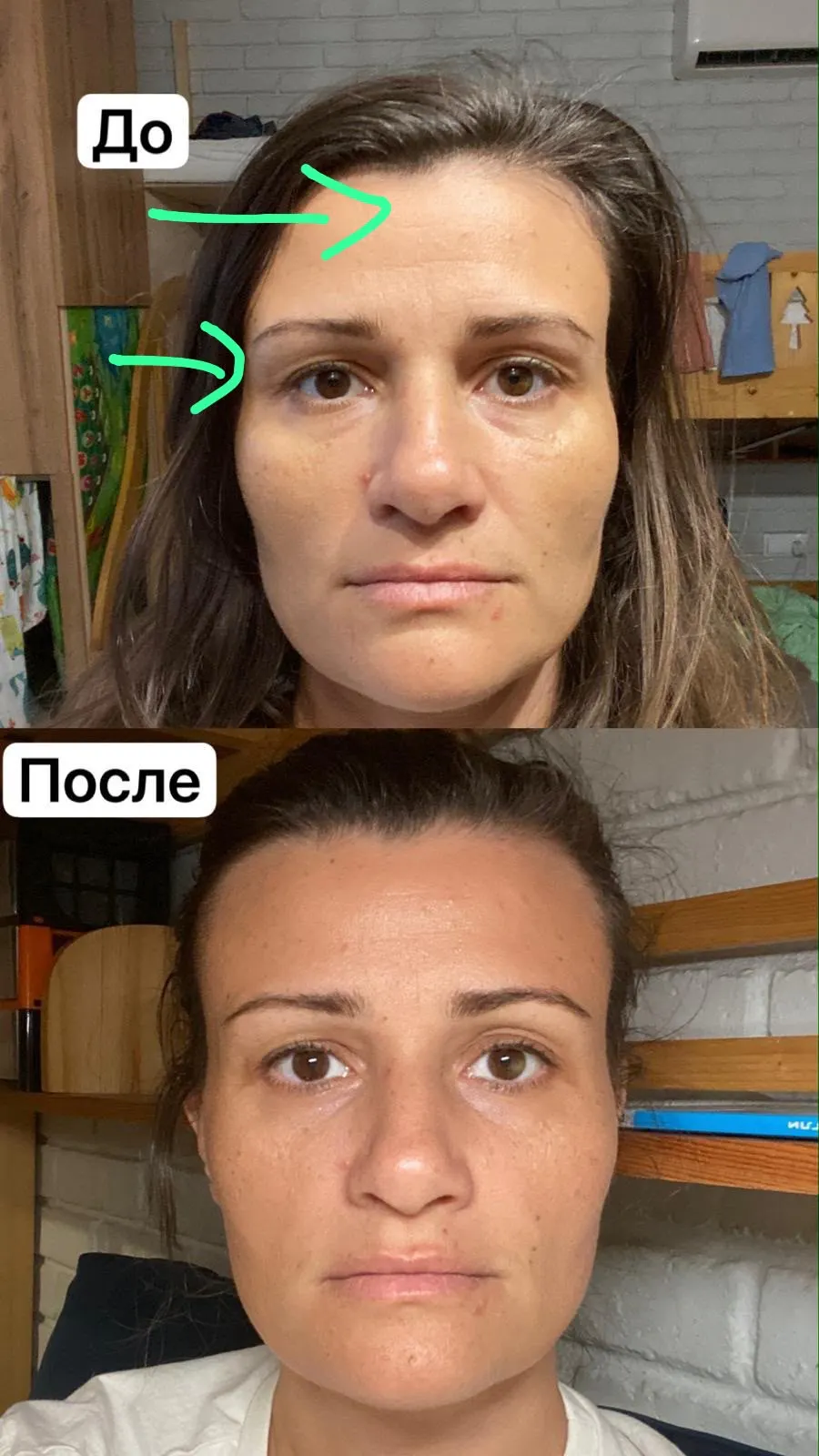 Before and after facial transformation showing reduced puffiness and firmer skin